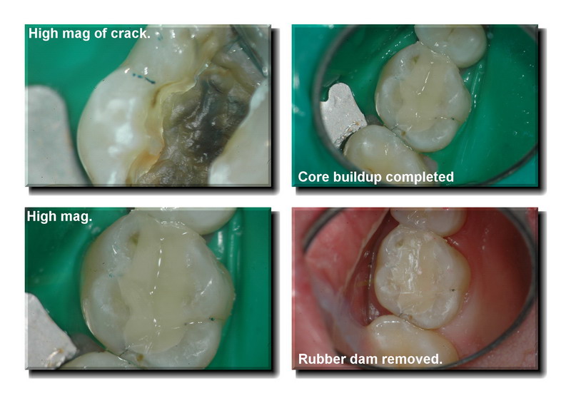 Cracked tooth pg 5 edited_resize.jpg